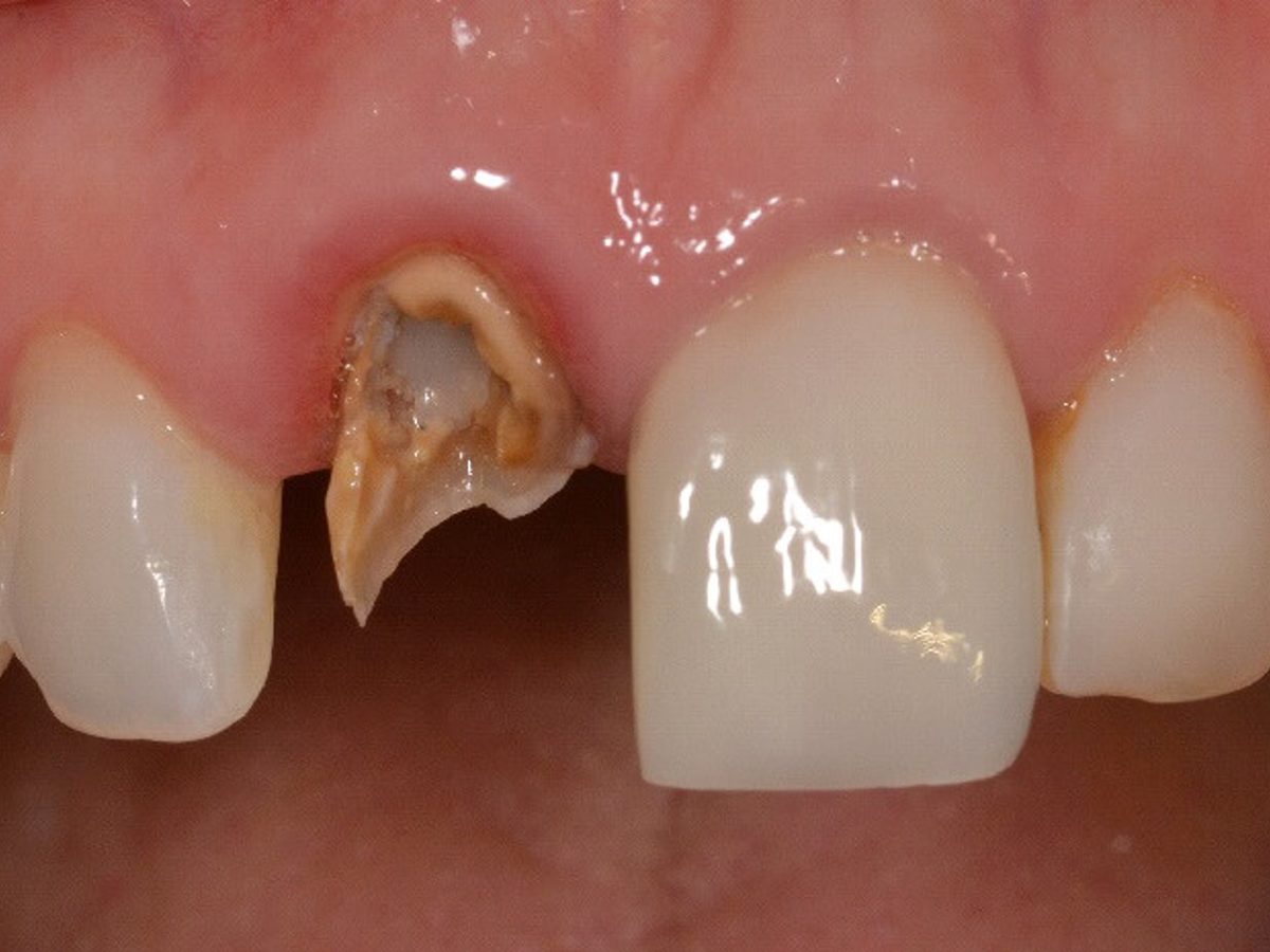 Close-up of a fractured front tooth before repair